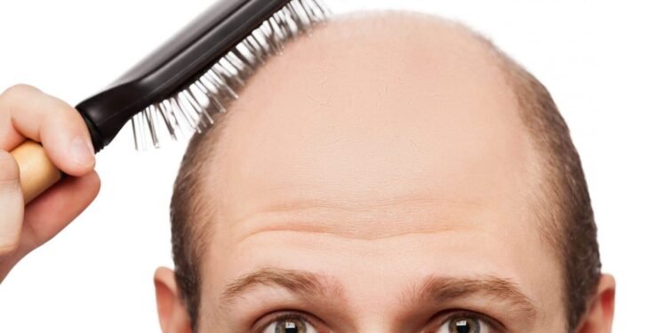 بشرى للمصابين بالصلع.. علماء يبتكرون علاجا جديدا قد ينهي المشكلة